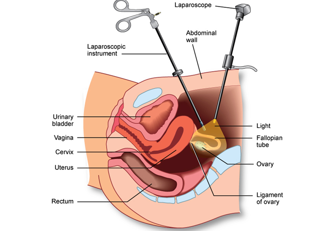 Basic Laparoscopy