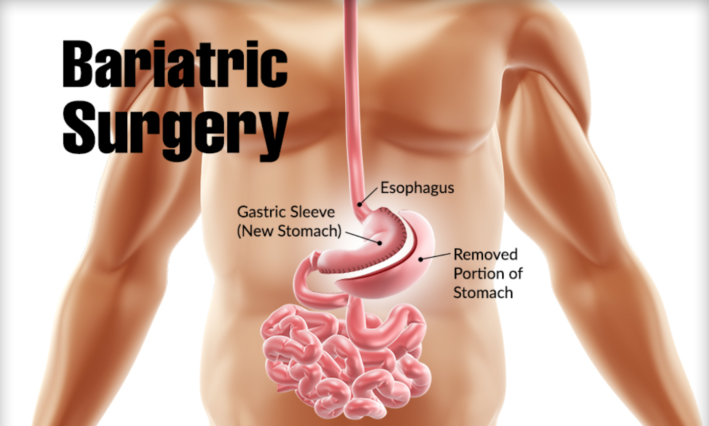 Bariatric Surgery