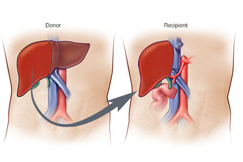 Liver Transplant
